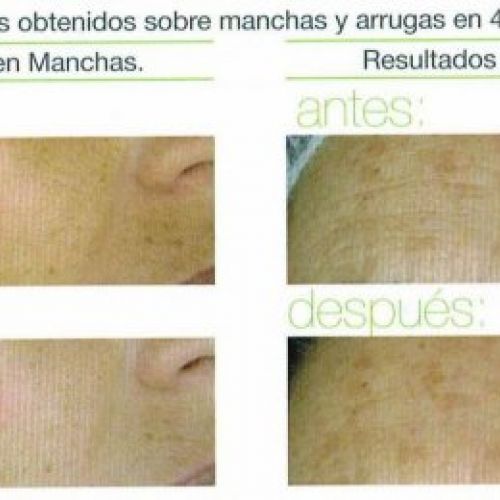 Antes y después del tratamiento AOX